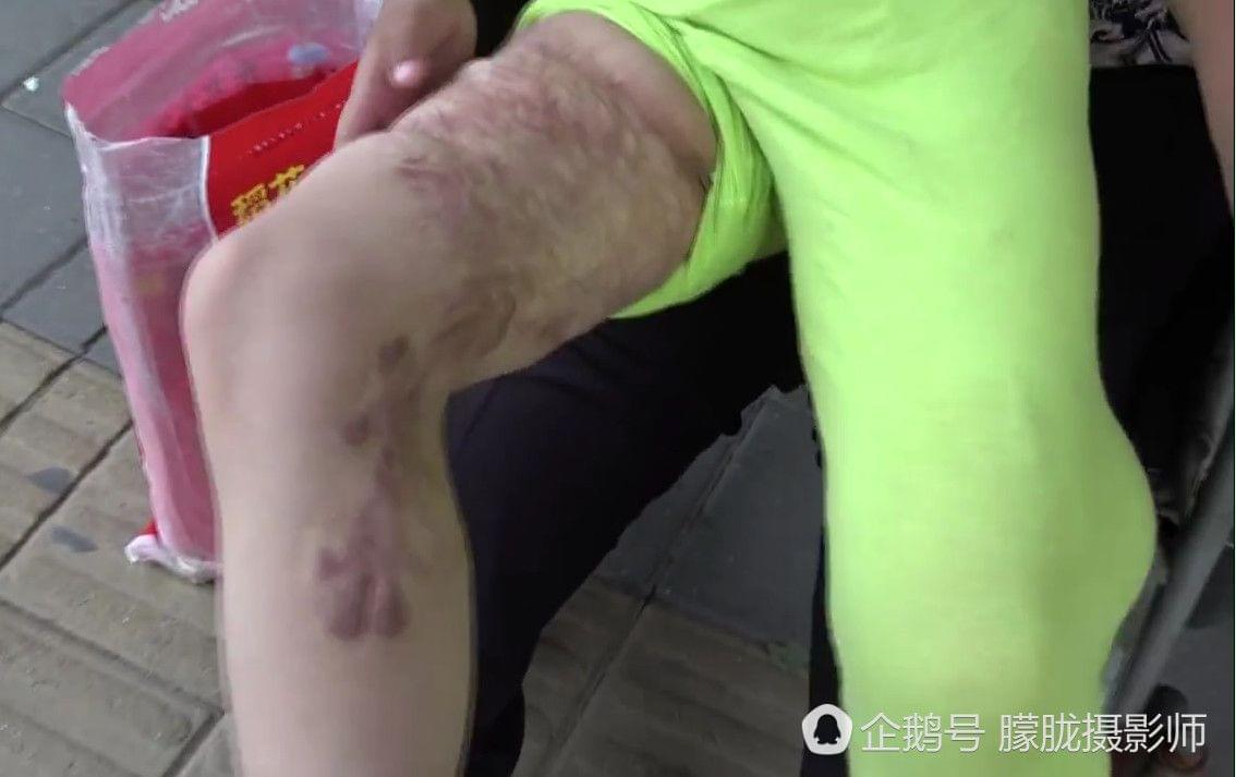 广东女童校园遭开水烫伤事件，警钟长鸣，呼吁加强校园安全监管