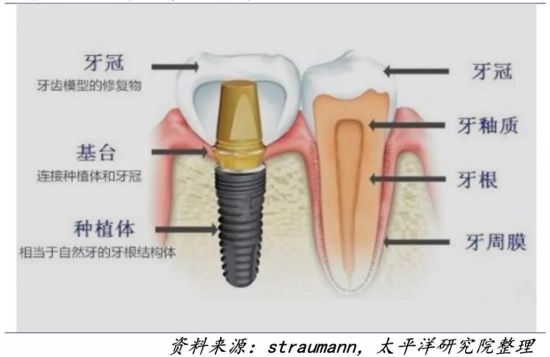 北京种植牙集采最新动态2023，科技引领口腔美学革新，开启种植牙新时代