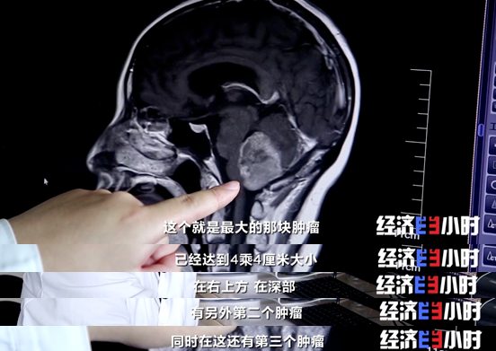 脑瘤最新药物，生命的希望之光