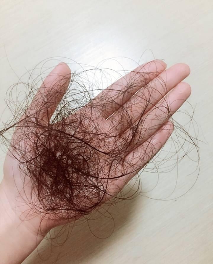 普秃最新治疗揭秘，告别脱发，开启新生活！