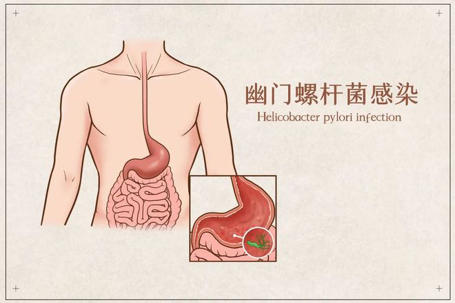 幽门螺旋杆菌最新治疗方法详解与论述